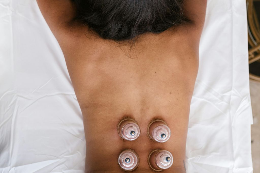 cupping therapy